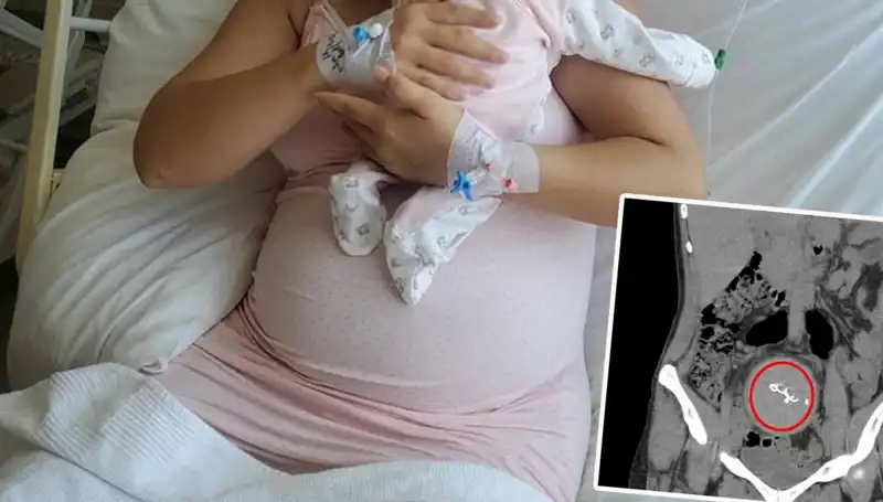 İki Yıl Sonra Ortaya Çıkan İhmal: Doğumda Unutulan Gazlı Bez Olayı